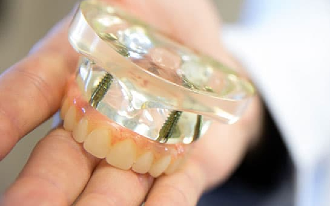 full mouth dental implants